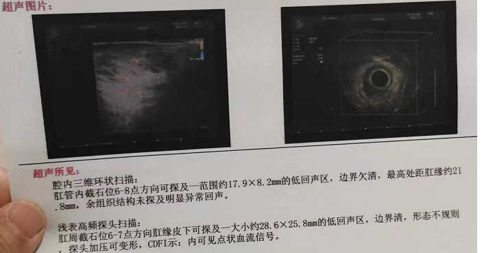 肛门B超检查.png