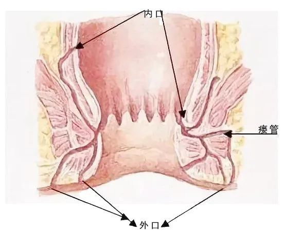 肛瘘4.jpg